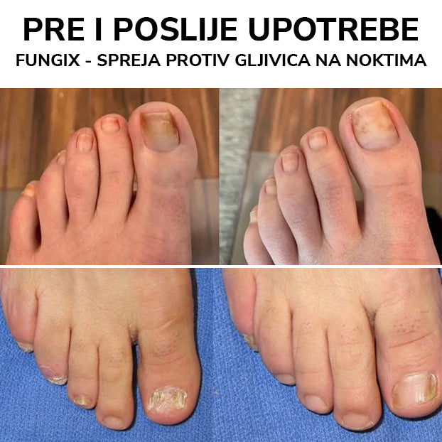 FungiX - Sprej Protiv Gljivica Na Noktima